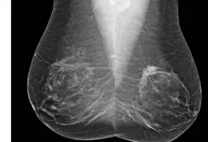 Las mamografías son la mejor forma de detección del cáncer de mama / RADIOLOGICAL SOCIETY OF NORTH AMERICA