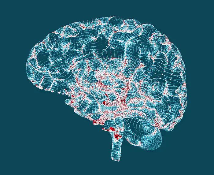 Imagen de un cerebro con marcadores de Alzheimer